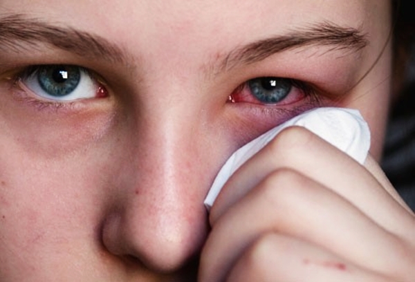Hiểu và phòng bệnh đau mắt đỏ